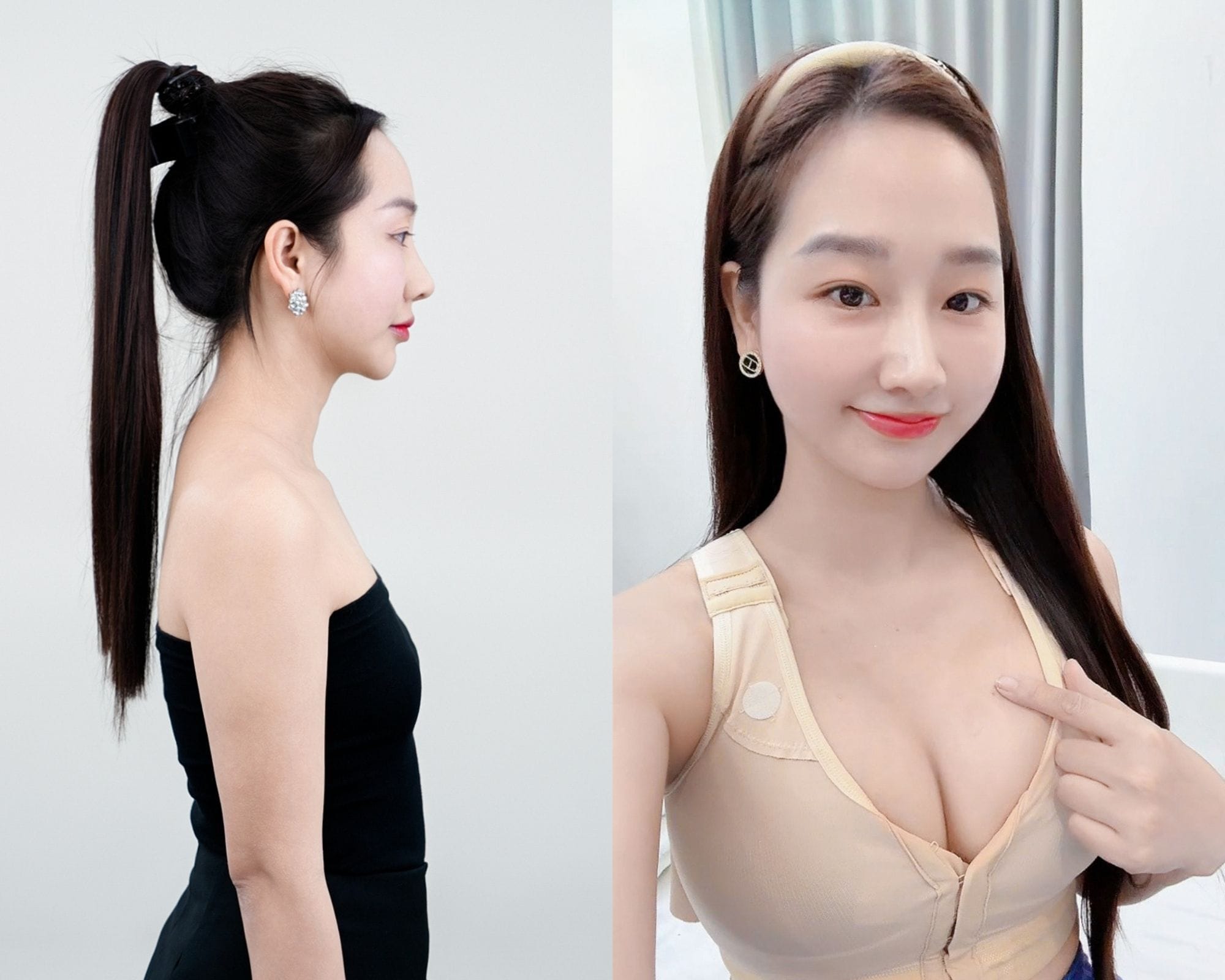 Nâng ngực cải thiện kích thước vòng 1