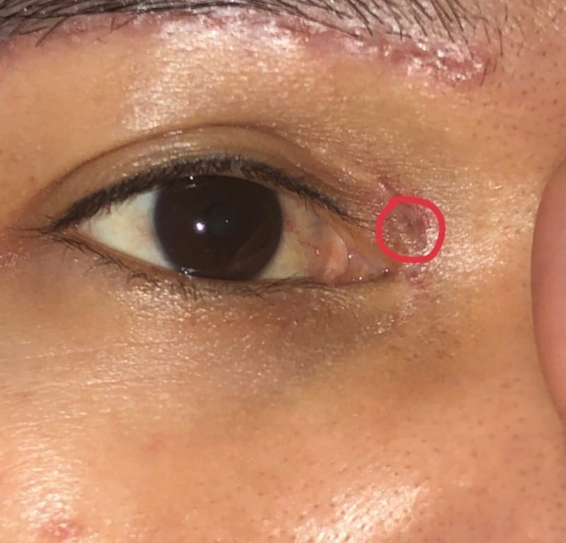 Tình trạng sót chỉ mí mắt không quá nghiêm trọng