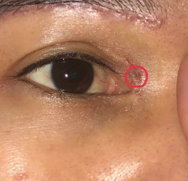 The issue of a retained eyelid suture is not overly serious. 