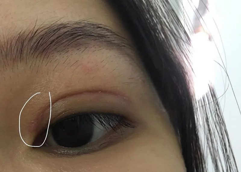 Visible sutures, swelling and pain, or infection of the eyelid 
