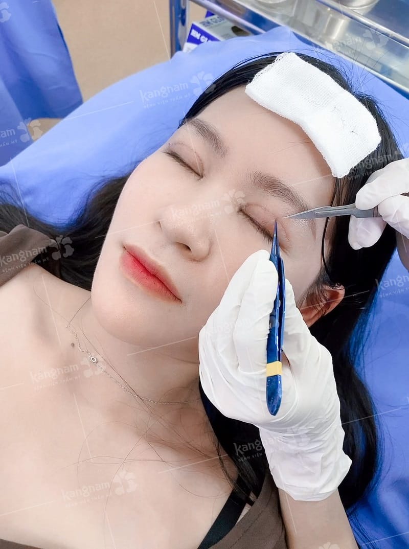 Cắt chỉ không khéo léo có thể làm sót chỉ