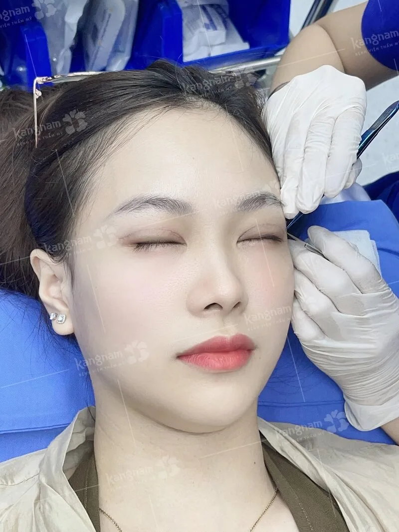 The suture removal process at Kangnam is gentle and precise. 