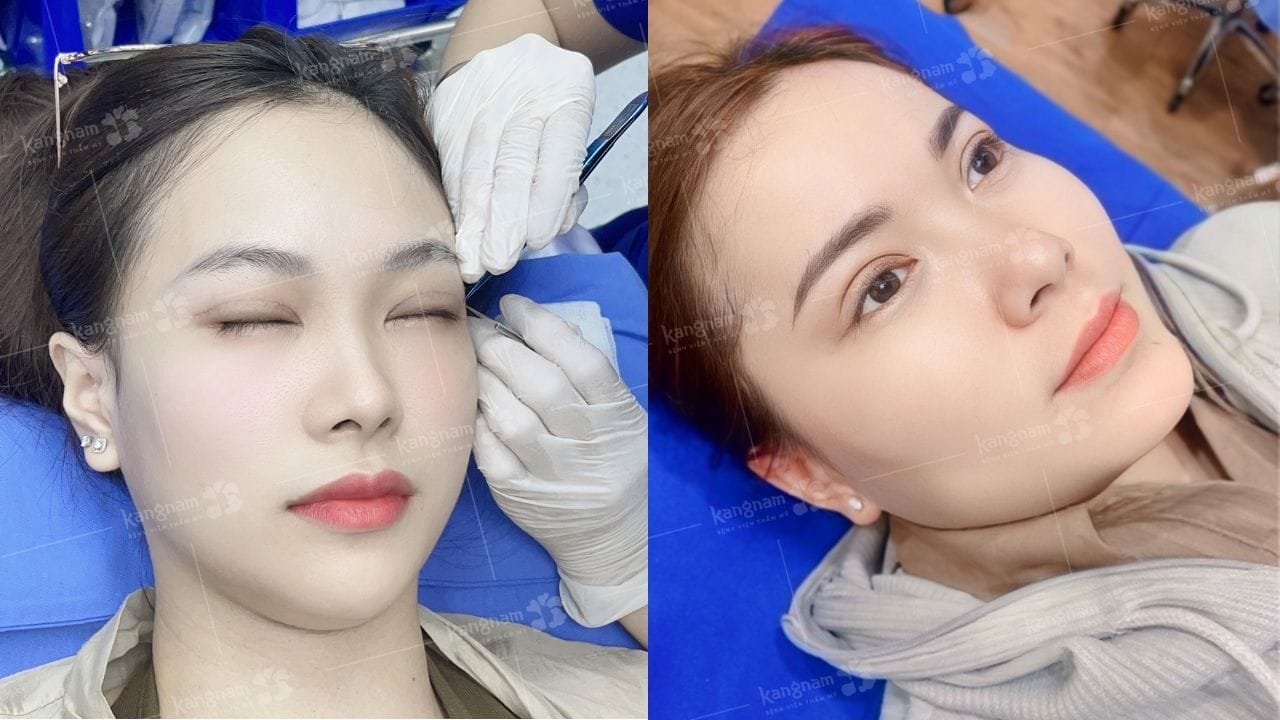 Cắt chỉ mí mắt sau mấy ngày? Cách chăm sóc nhanh lành