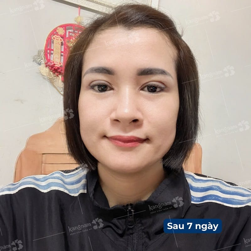 Vết thương mí mắt khô, không còn chảy dịch