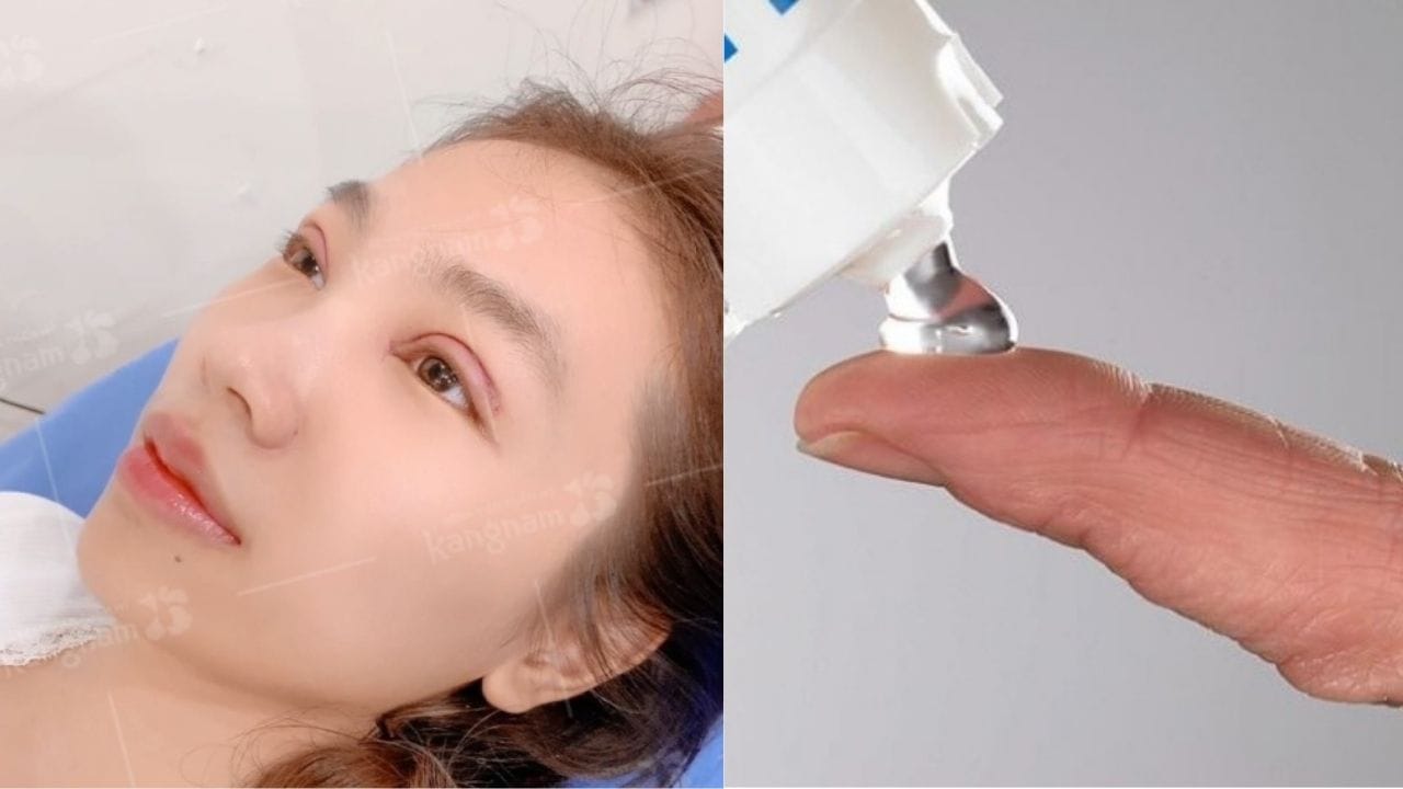 Cắt mắt 2 mí có để lại sẹo không? các giai doạn phục hồi