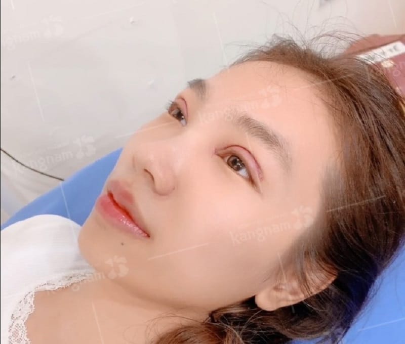 Cắt mí đúng kỹ thuật sẽ không để lại sẹo