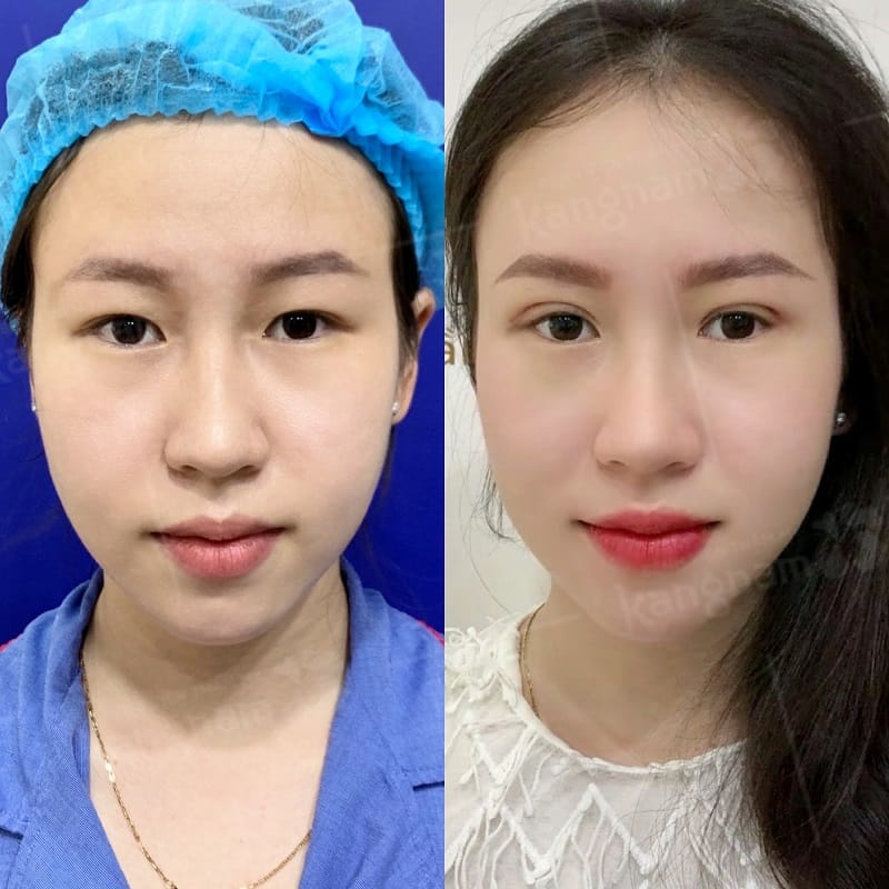 Mí mắt sẽ mờ sẹo chỉ sau vài tháng