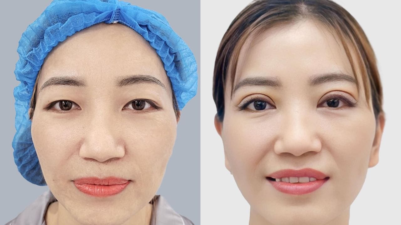 Cắt mí bao lâu thì hồi phục? các mốc thời gian cụ thể