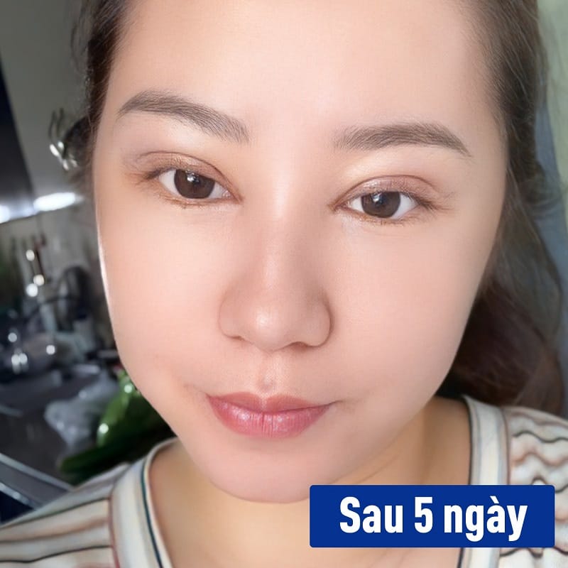 Những ngày đầu mới cắt mí vết thương còn hơi sưng