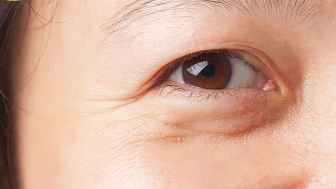 Cắt mí có giữ được vĩnh viễn không?