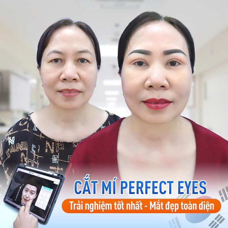 Cắt mí tại Kangnam duy trì nếp mí lâu dài