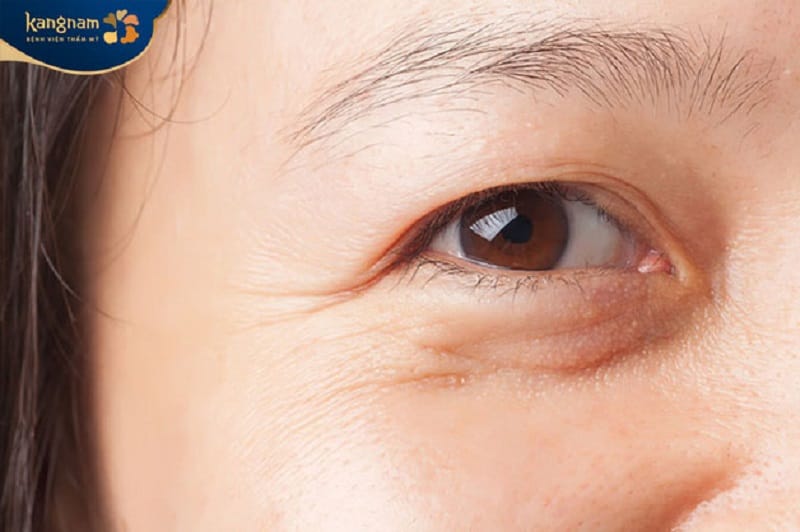 Da mí mắt bị lão hóa nên không thể duy trì vĩnh viễn sau cắt mí