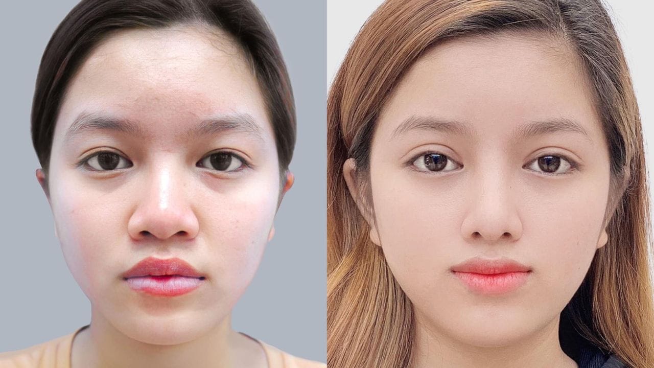 Cắt mí mắt được bao nhiêu năm? Những cách duy trì hiệu quả