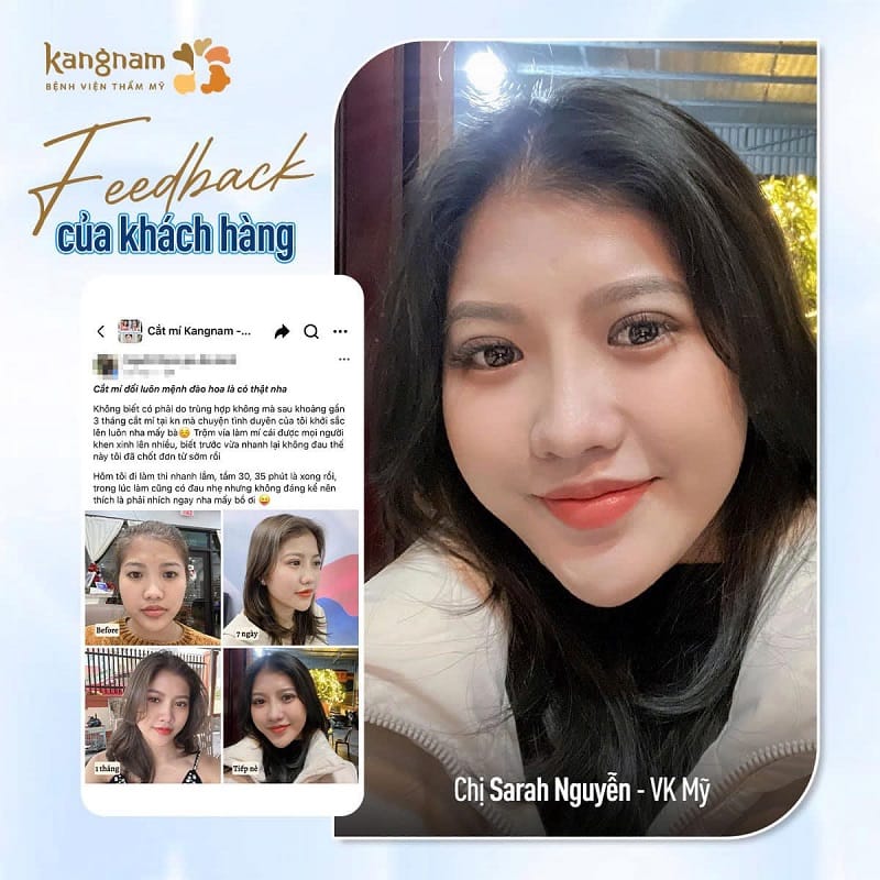 Khách hàng Việt kiều có phản hồi tích cực sau khi cắt mí tại Kangnam