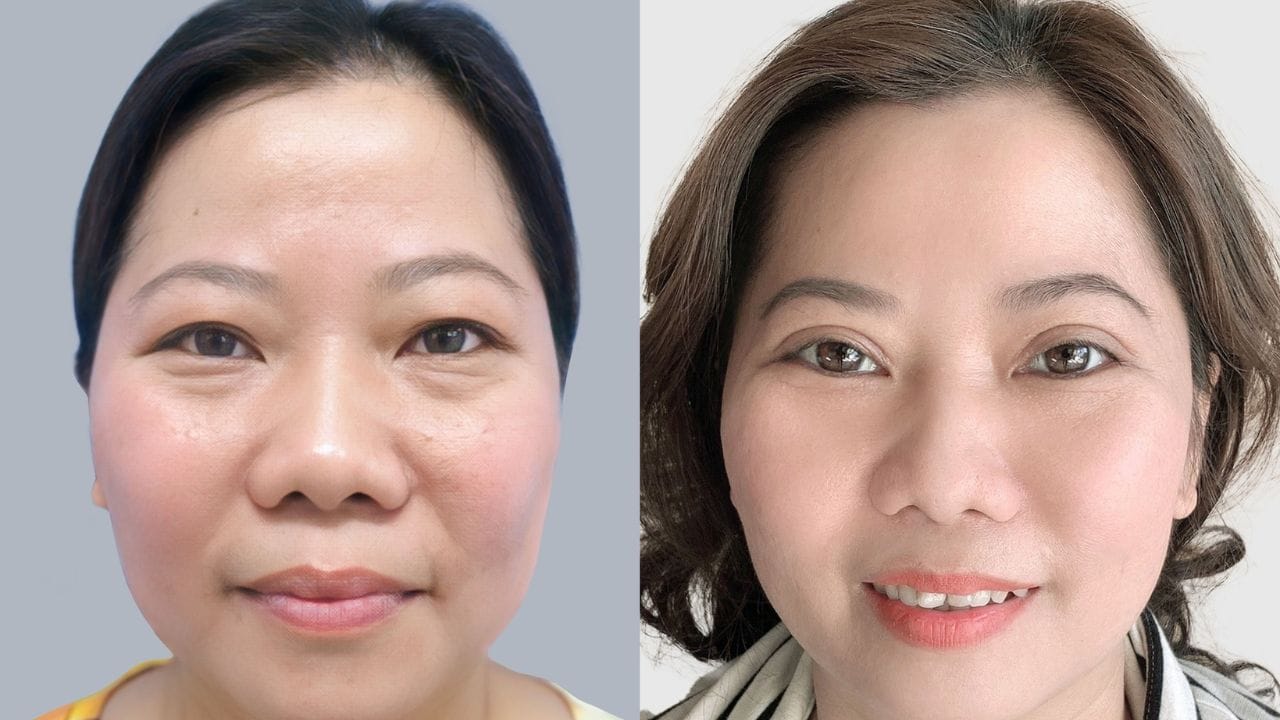 Cắt mí khi về già có phải cắt lại không?