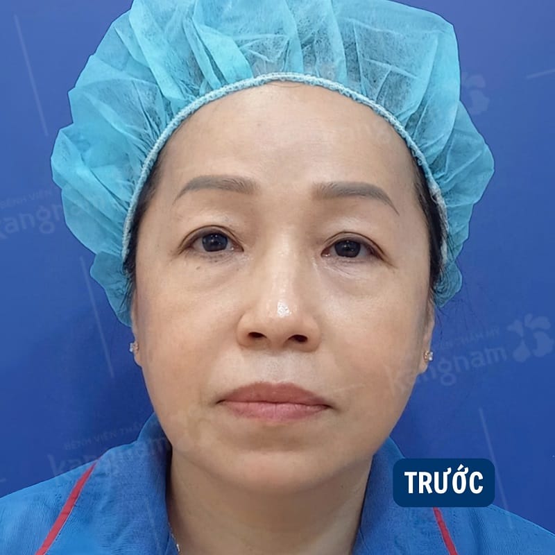 Mí mắt sụp, che khuất tầm nhìn 