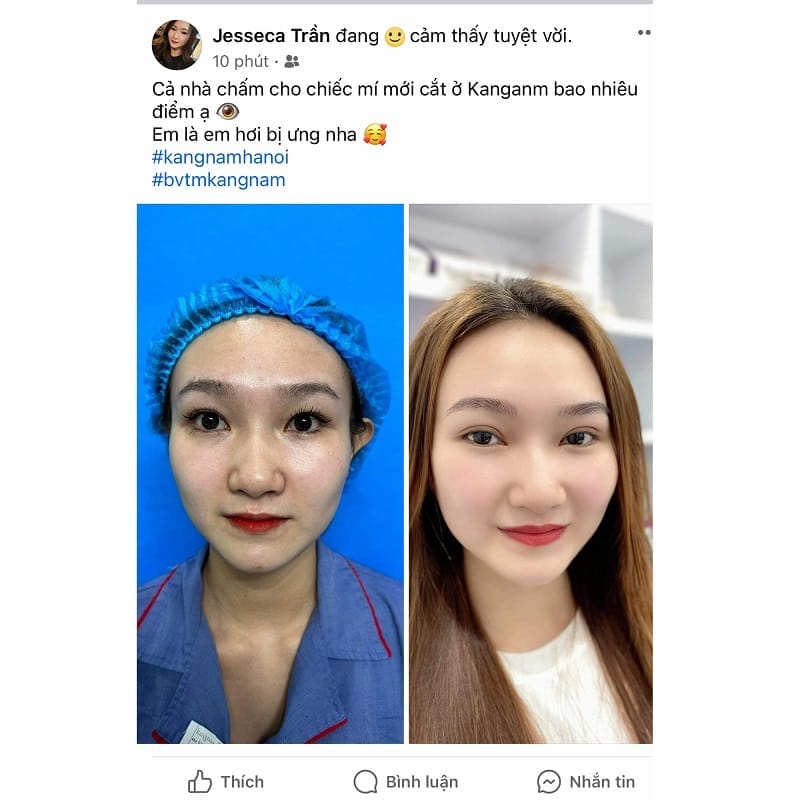 Khách hàng Việt kiều hài lòng với kết quả cắt mí