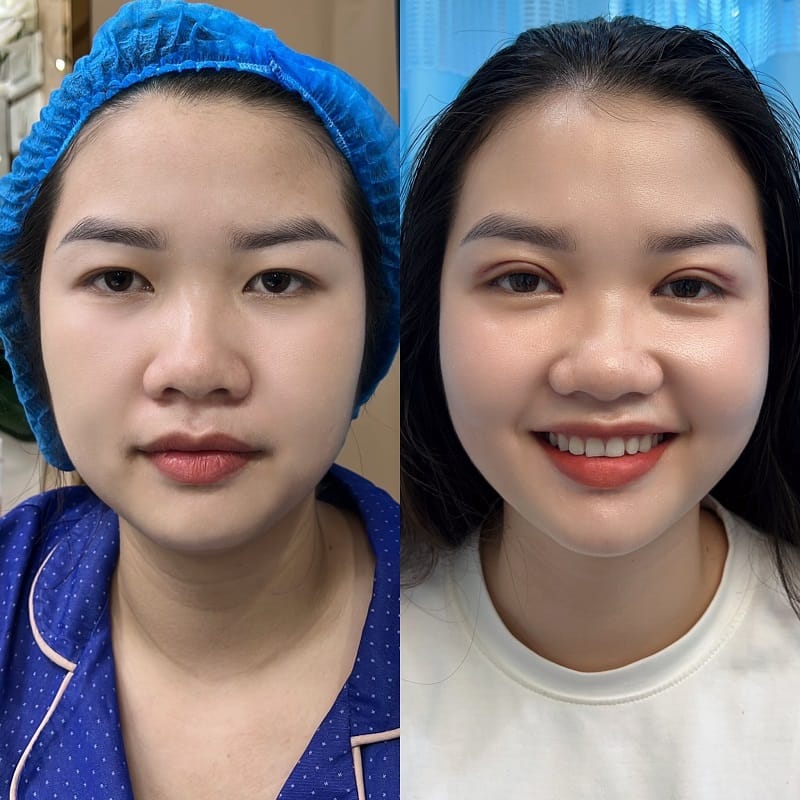 Nếp mí sau cắt ổn định nhanh, cân đối và hài hòa