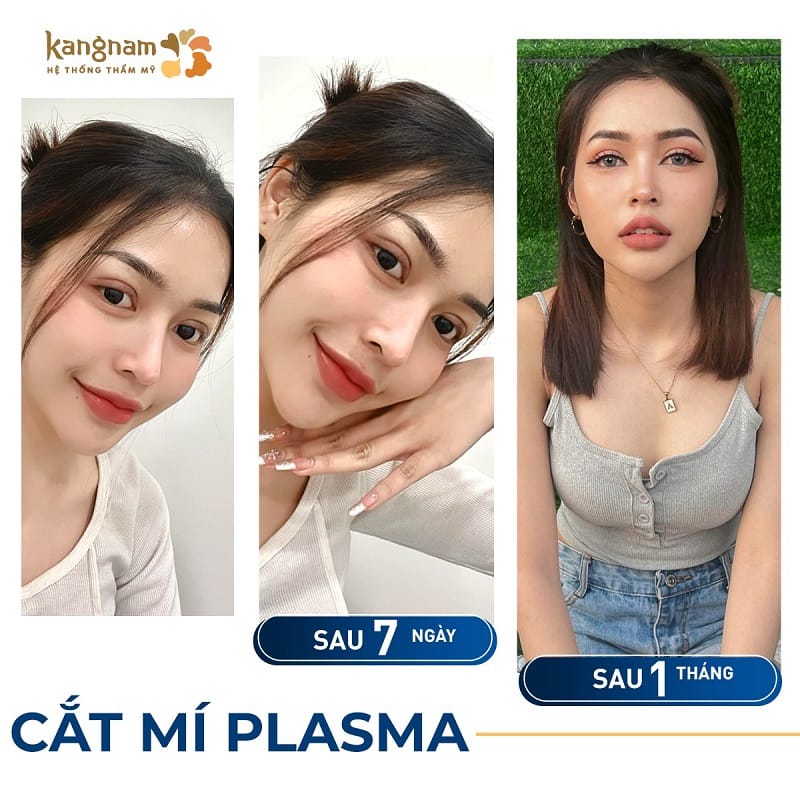 Nếp mí mới cân đối và hài hòa với khuôn mặt