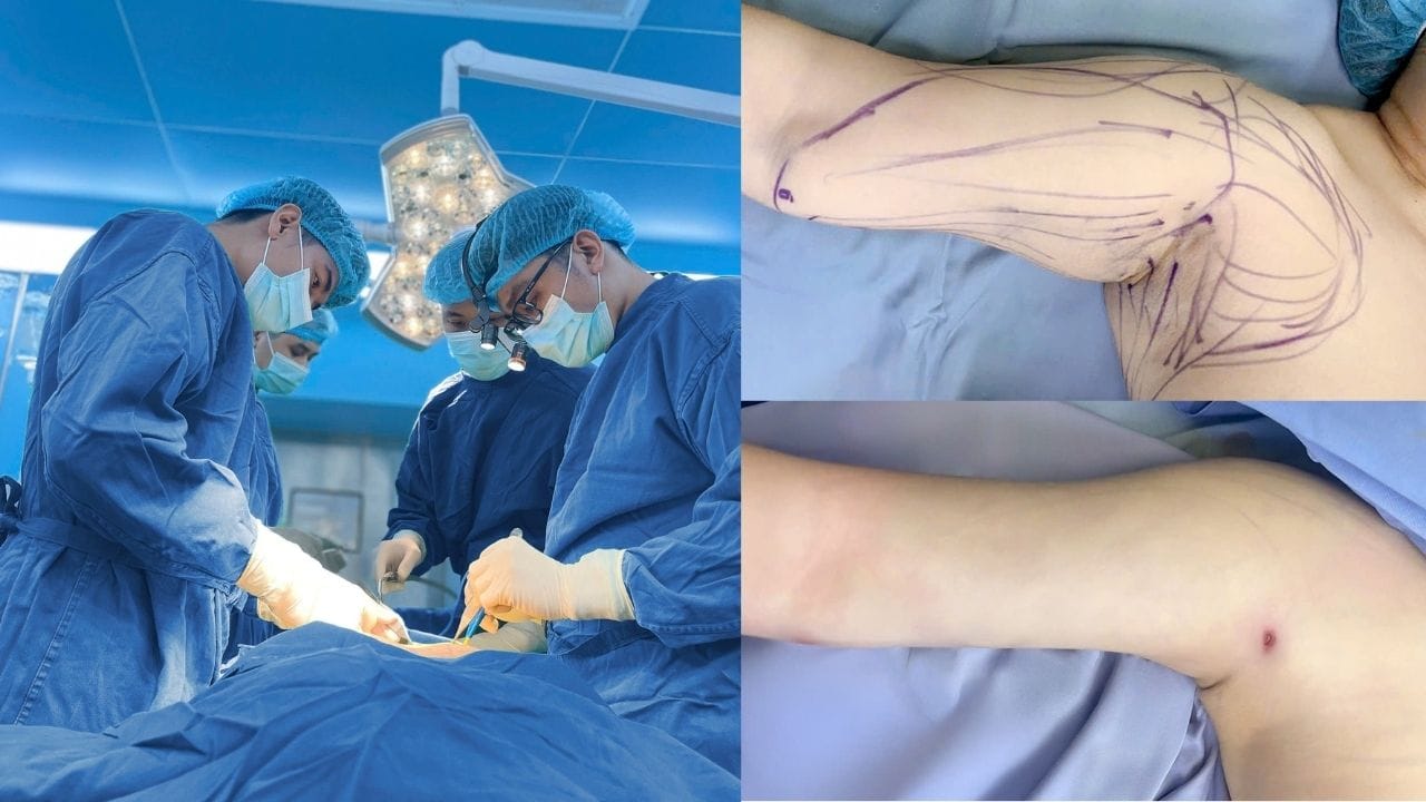 Hút mỡ bắp tay giá bao nhiêu? Yếu tố ảnh hưởng đến chi phí