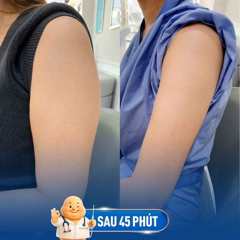 Khách hàng sở hữu cánh tay thon gọn sau khi hút mỡ