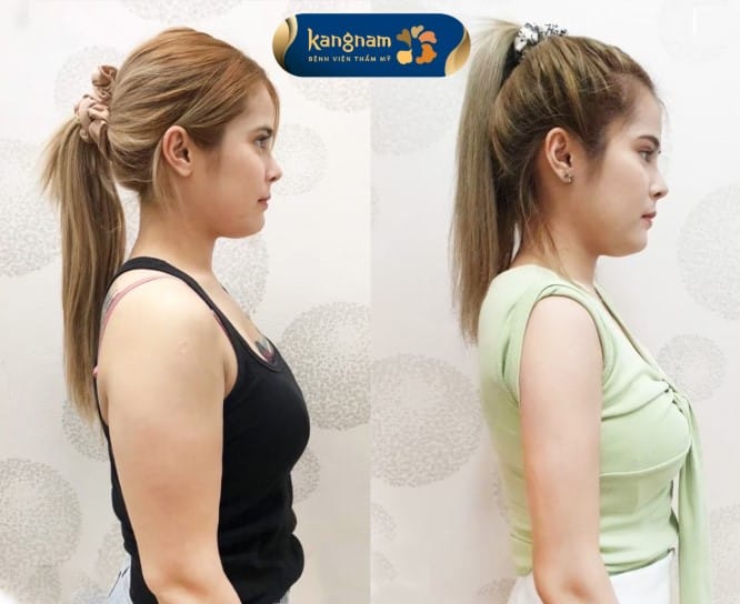 Khách hàng Việt kiều hài lòng với kết quả hút mỡ bắp tay