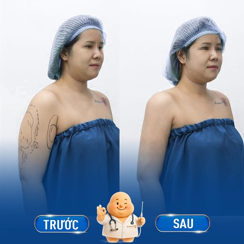 Những người bắp tay tích tụ nhiều mỡ thừa, nên thực hiện hút mỡ