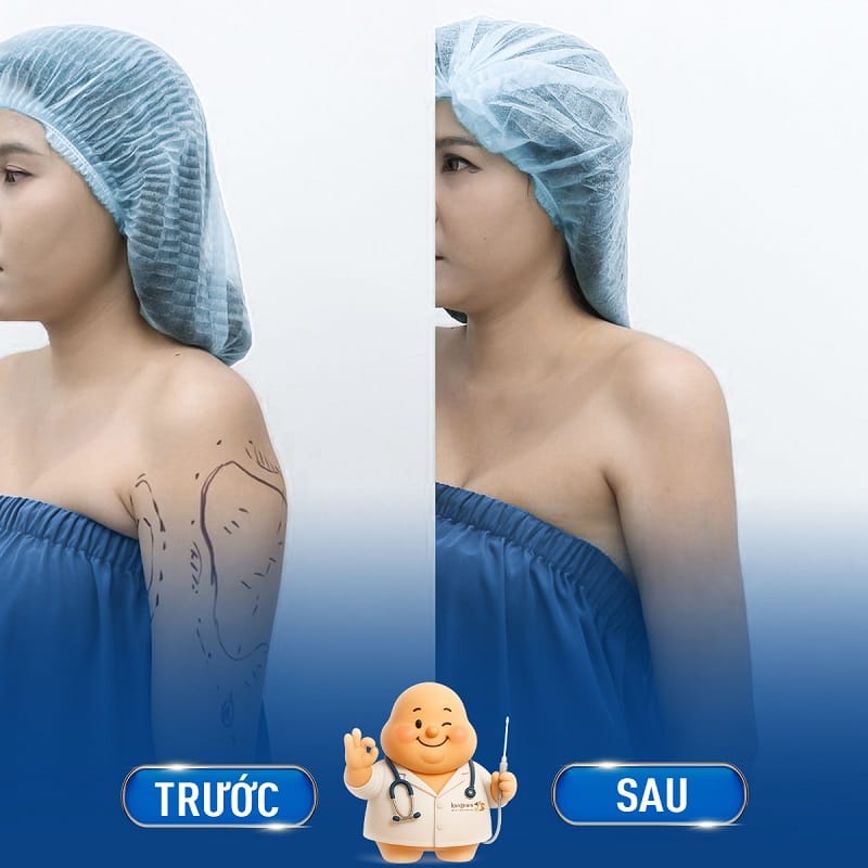 Bắp tay thon gọn kết hợp chế độ chăm sóc đúng cách, sẽ duy trì hiệu quả lâu dài