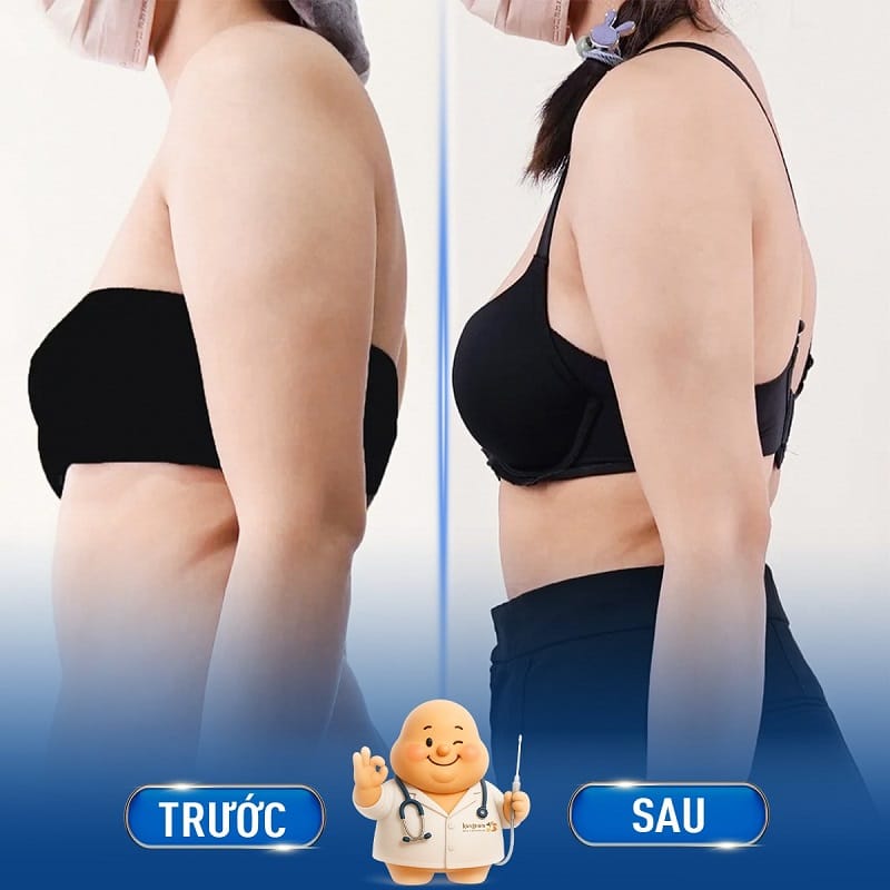 Bắp tay khách hàng thon gọn, cân đối hơn