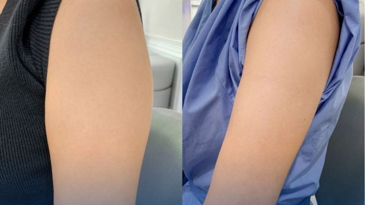 Hút mỡ bắp tay Kangnam – Sở hữu cánh tay thon gọn, săn chắc chỉ sau 1 lần