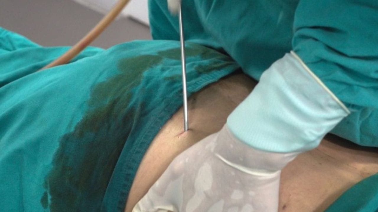 Hút mỡ bụng có nguy hiểm không? Những biến chứng có thể xảy ra