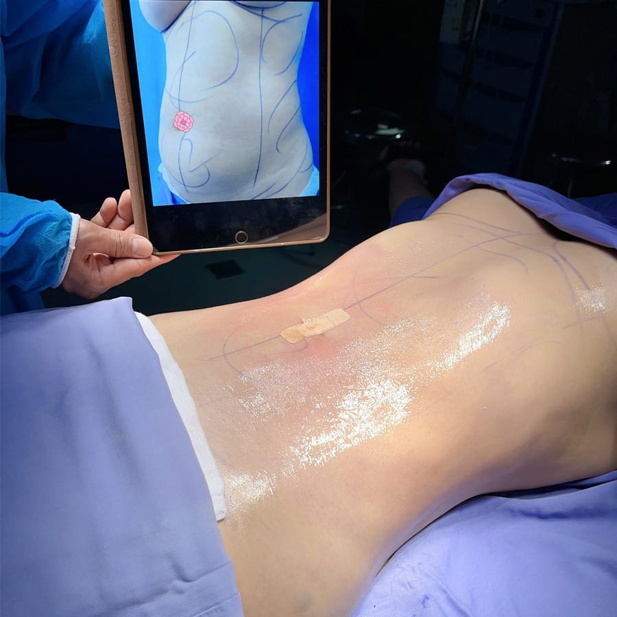 Hút mỡ bụng Kangnam: Giải pháp sở hữu vòng eo thon gọn lâu dài