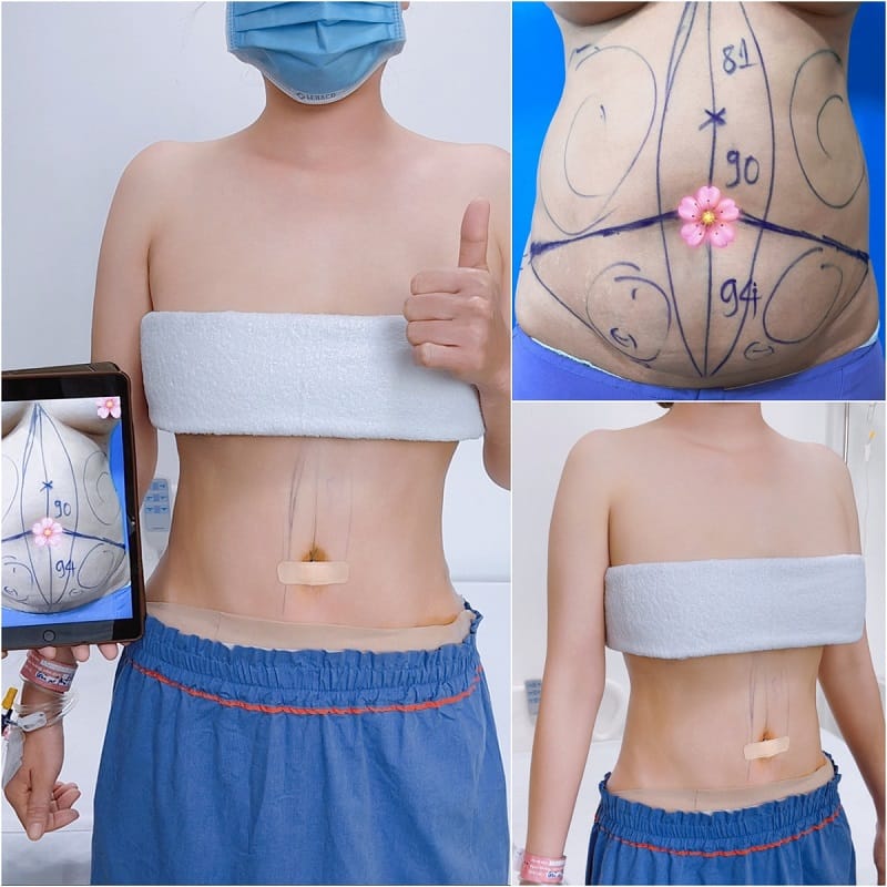 Mỡ thừa được hút ra ngoài an toàn và nhẹ nhàng