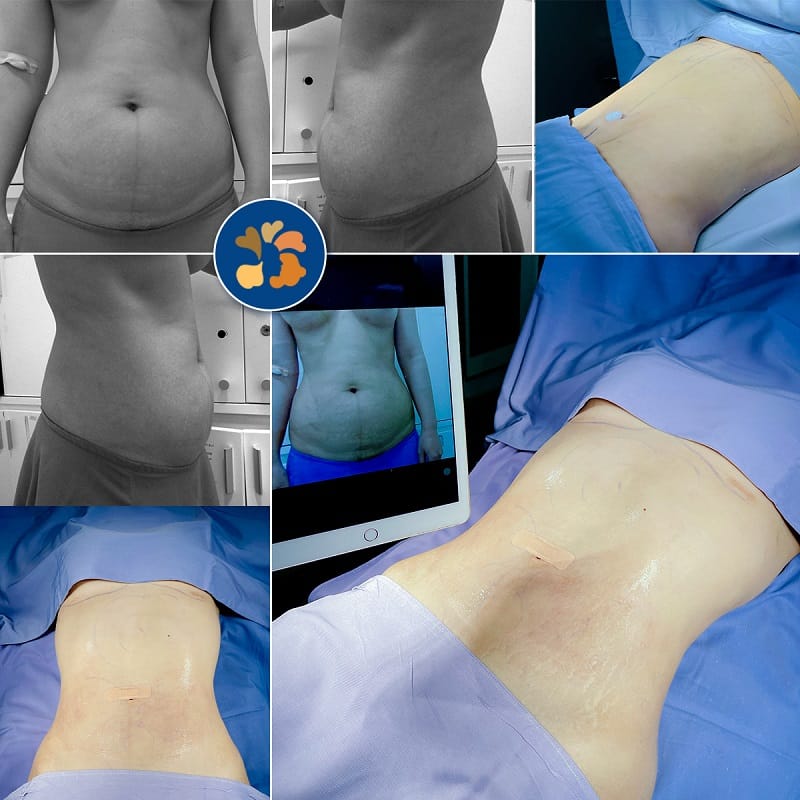 Quá trình hút mỡ diễn ra nhẹ nhàng, không gây đau