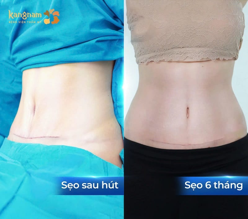 Vết sẹo sau hút mỡ mờ dần sau một thời gian chăm sóc