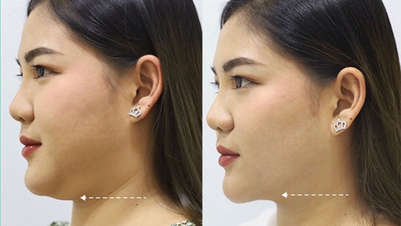 Hút mỡ nọng cằm Kangnam – Cằm thon gọn, an toàn, nhanh hồi phục