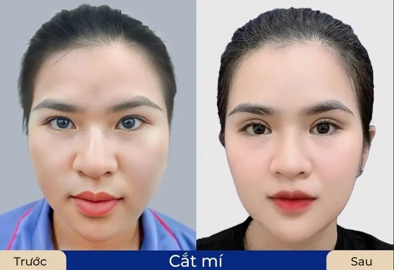 Cắt mí giúp khắc phục tình trạng da thừa, chùng nhão