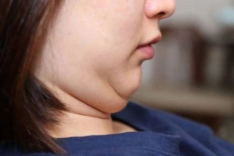 Người có nhiều mỡ tích tụ vùng cằm nên cân nhắc giảm mỡ