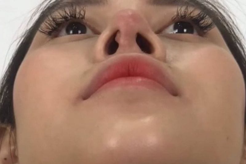 Va chạm mạnh khiến lòi sụn mũi