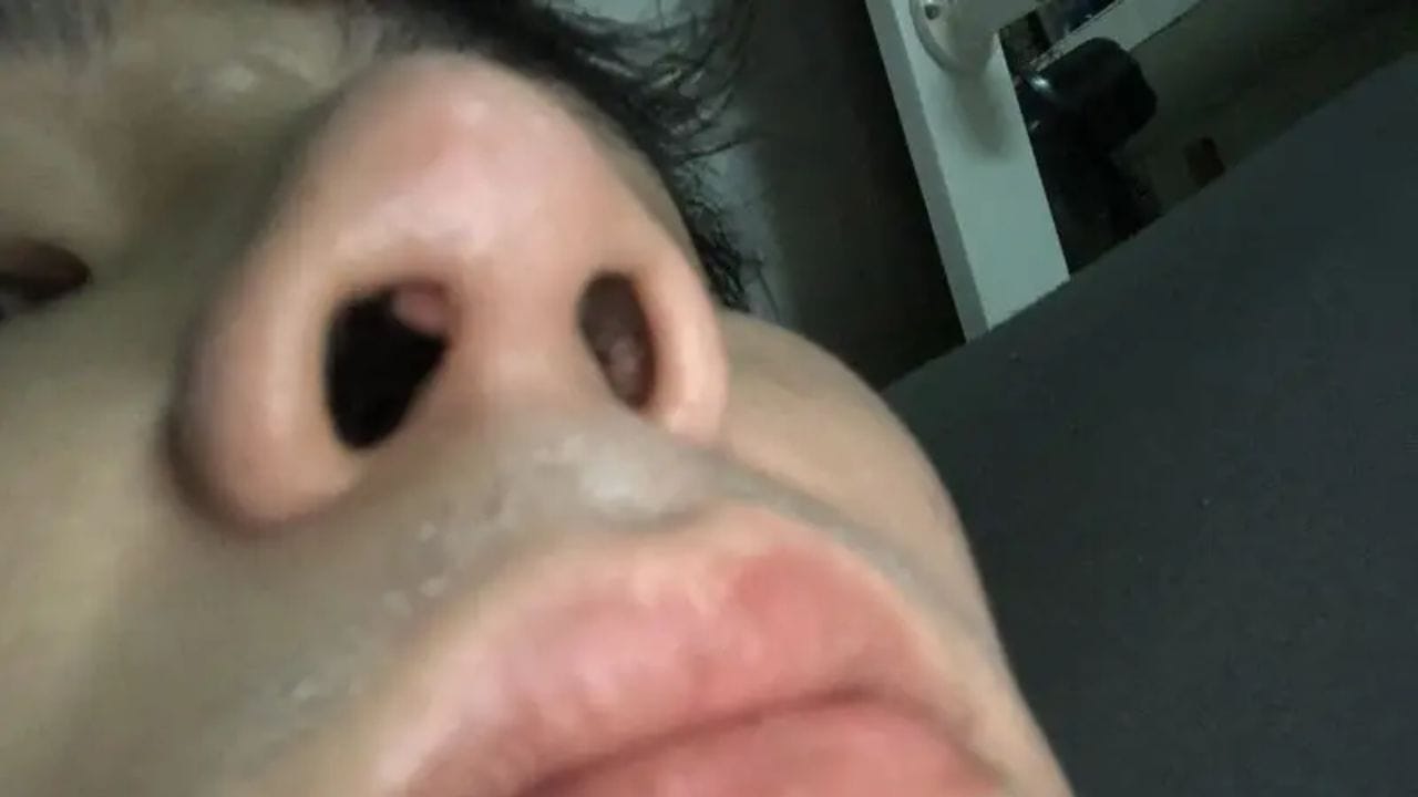 Nâng mũi bị lòi sụn vách ngăn: Nguyên nhân và cách xử lý an toàn