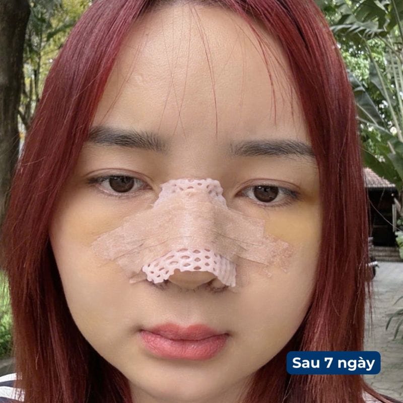 Vùng mũi mới phẫu thuật cần thời gian hồi phục