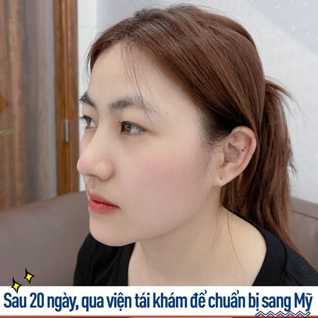Nhiều Việt kiều tin tưởng chọn Kangnam nâng mũi