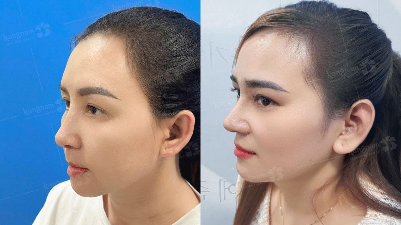 Nâng mũi ở đâu đẹp? Gợi ý địa chỉ uy tín, an toàn