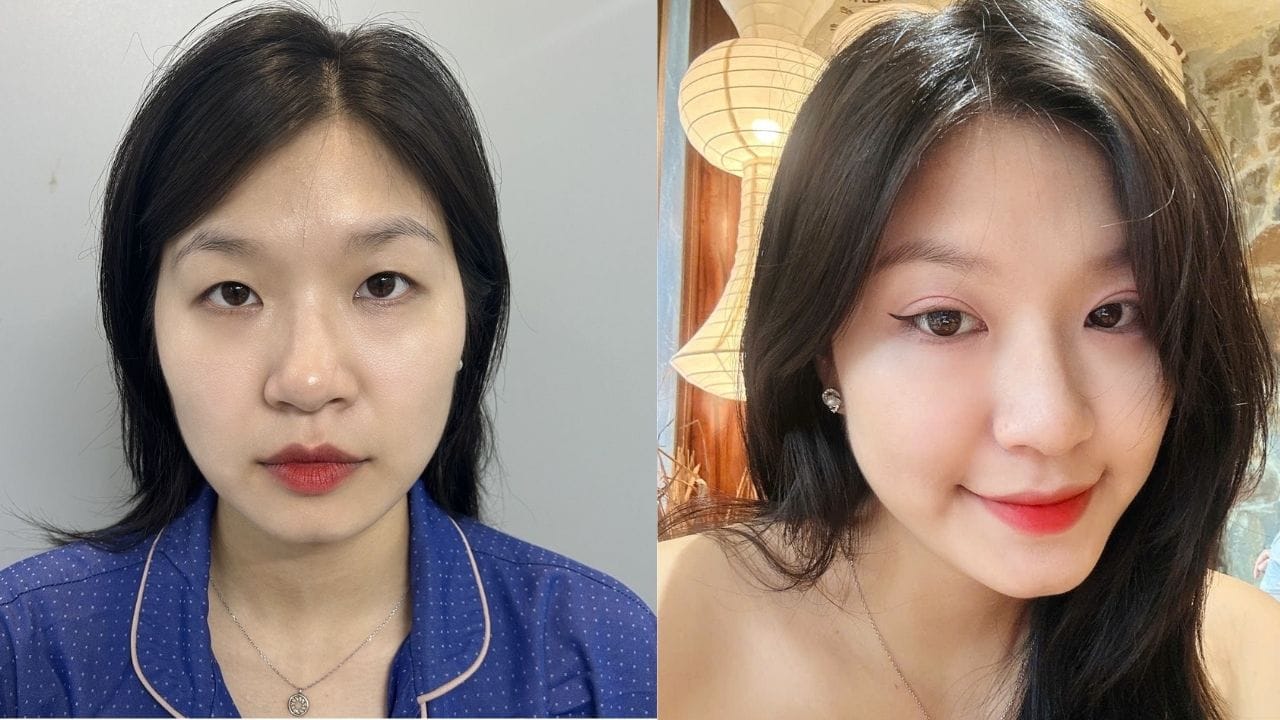 Nhấn mí bao lâu thì lành? Cách chăm sóc sau nhấn mí