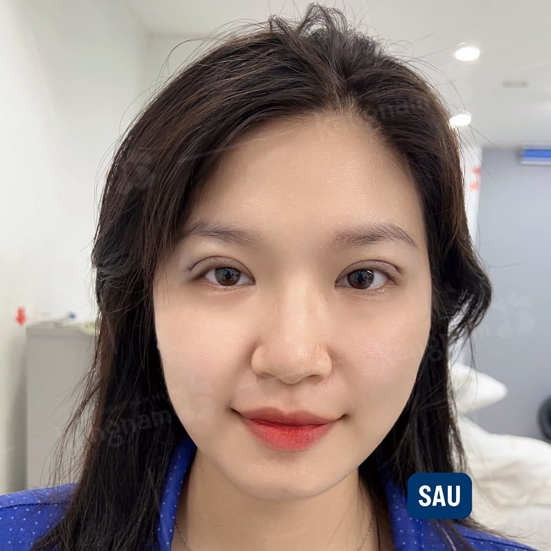 Khách hàng có cơ địa nhanh lành sẽ rút ngắn được thời gian hồi phục sau nhấn mí