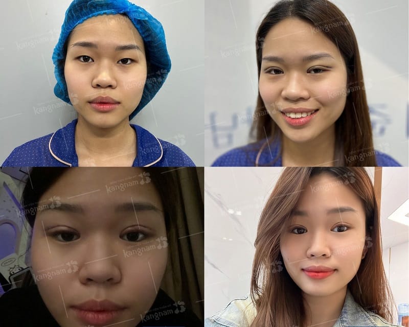 Nếp mí sẽ lành lại sau nhấn mí vài ngày