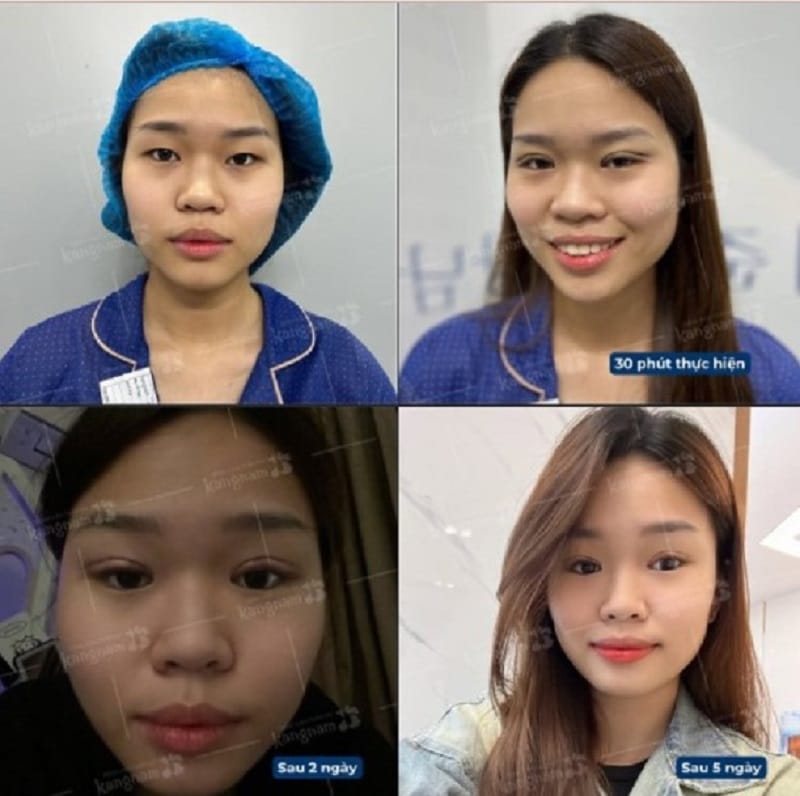 Để mí mắt phục hồi ổn định sau khấn mí