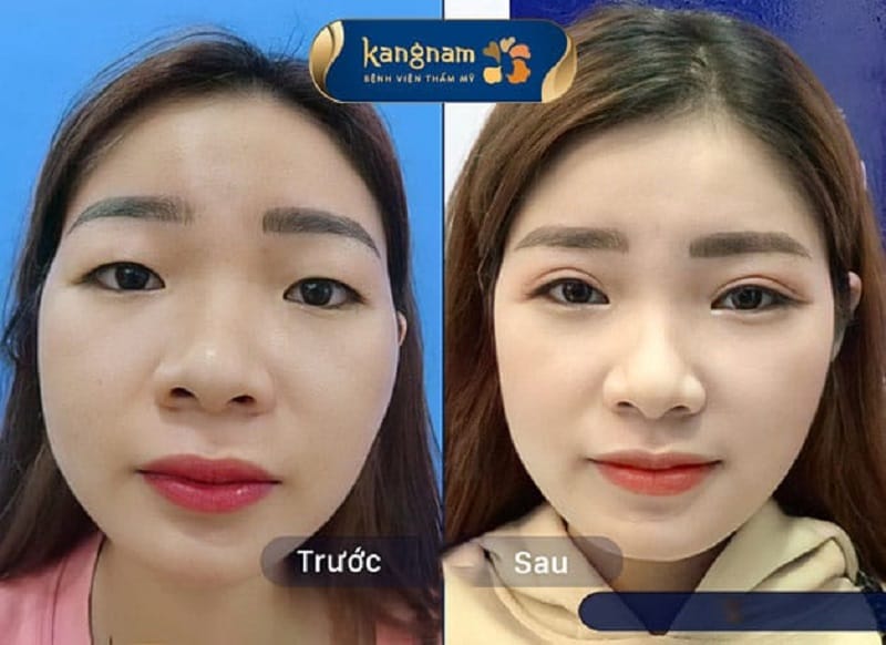 Sau vài tuần nếp mí sẽ ổn định và cân đối hơn