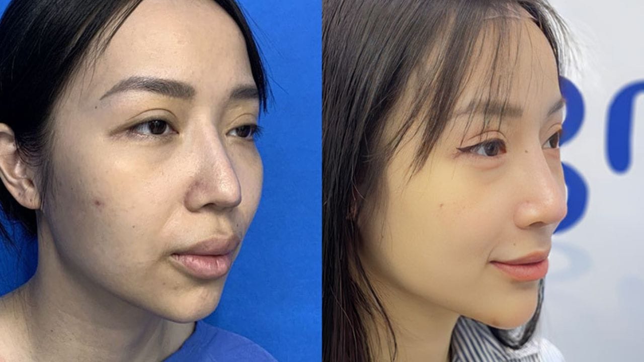 Sửa mũi Kangnam – Bí quyết lấy lại dáng mũi chuẩn tỷ lệ “vàng”