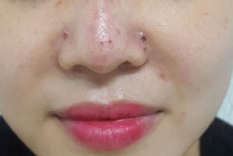 Sử dụng filler không rõ nguồn gốc